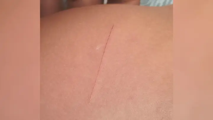 Criança é ferida na escola e passa por tratamento contra HIV em MG