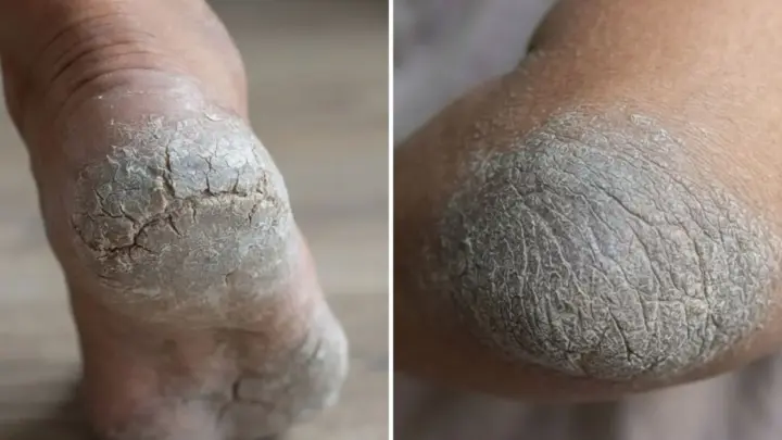 Como usar vaselina e hidratante para recuperar calcanhares e cotovelos ásperos no frio