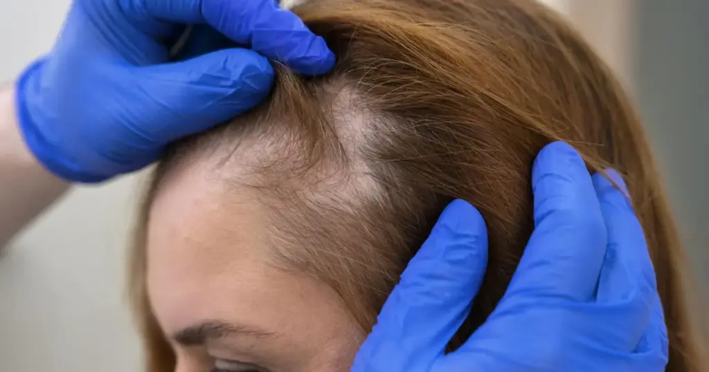 Queda de cabelo não é tudo igual: diagnóstico define o rumo do tratamento