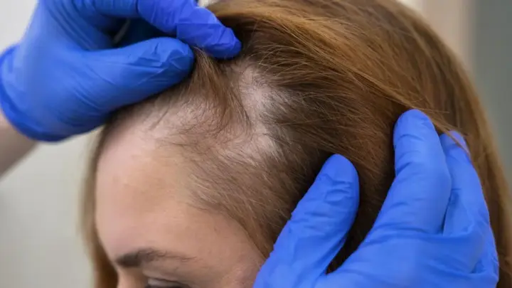Queda de cabelo não é tudo igual: diagnóstico define o rumo do tratamento