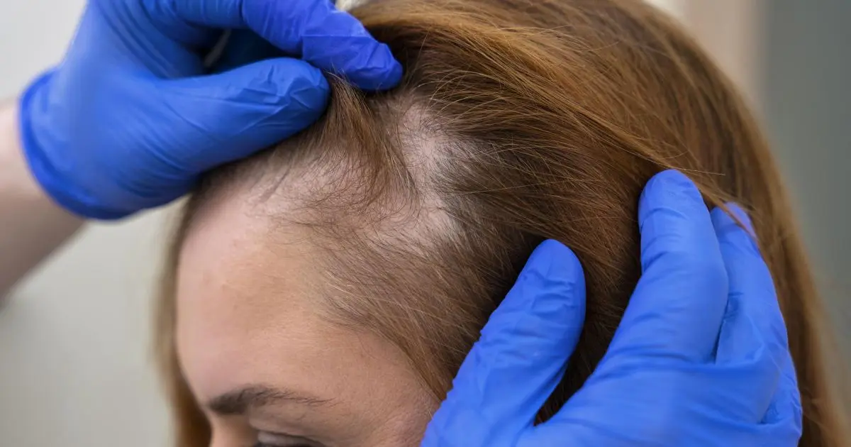 Queda de cabelo não é tudo igual: diagnóstico define o rumo do tratamento