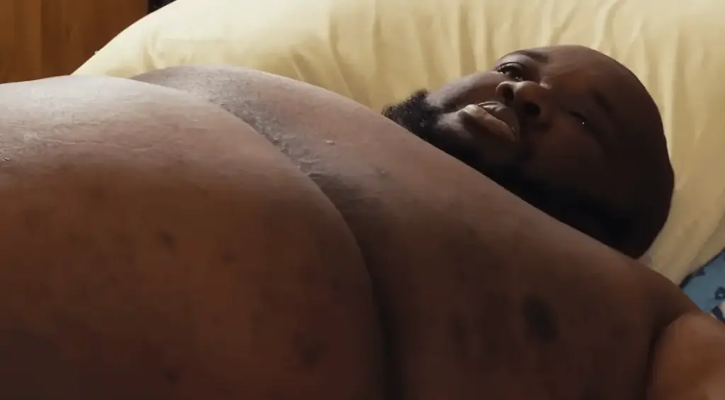 “Quilos Mortais”: veja como está Thederick, que tinha 336 kg e lipedema
